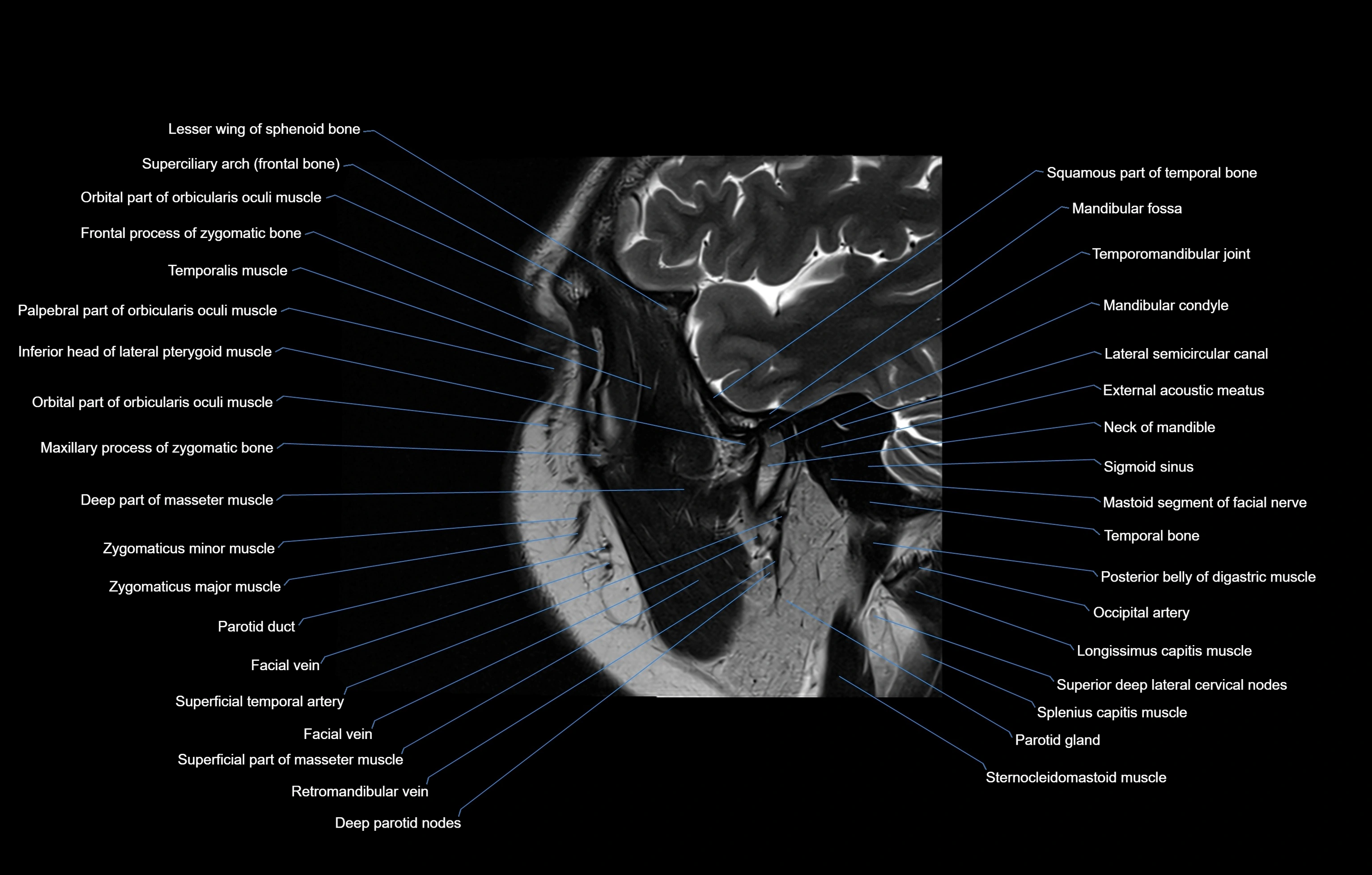 paranasal sinuses(PNS) MRI coronal  cross sectional anatomy 3T radiology  image-img-00001-00019.webp